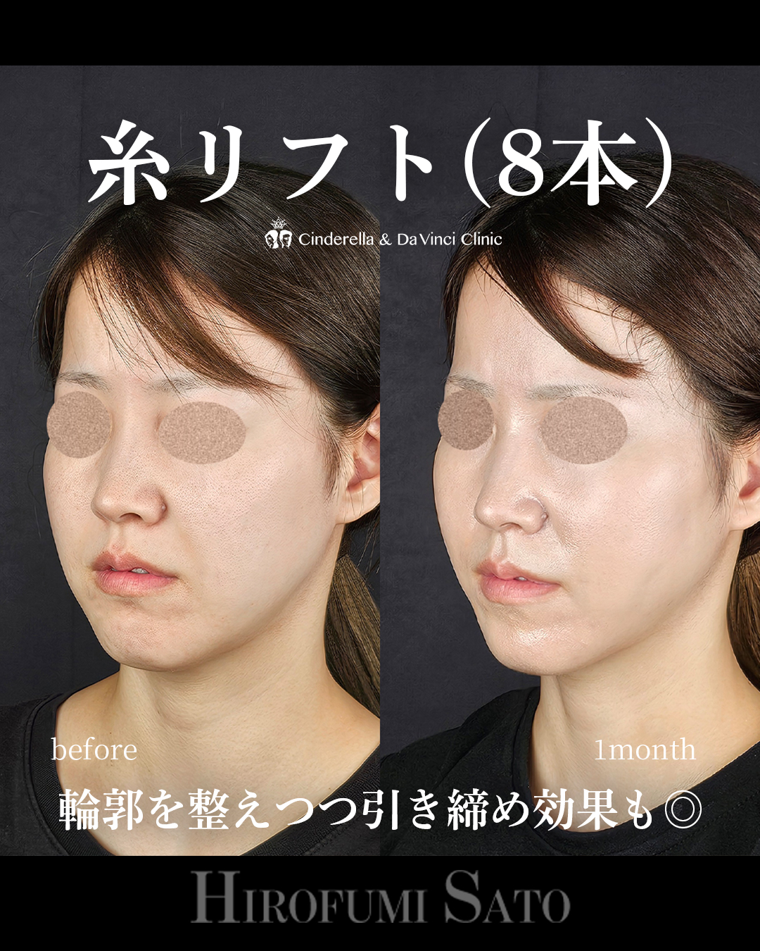 糸リフトで整えるの画像