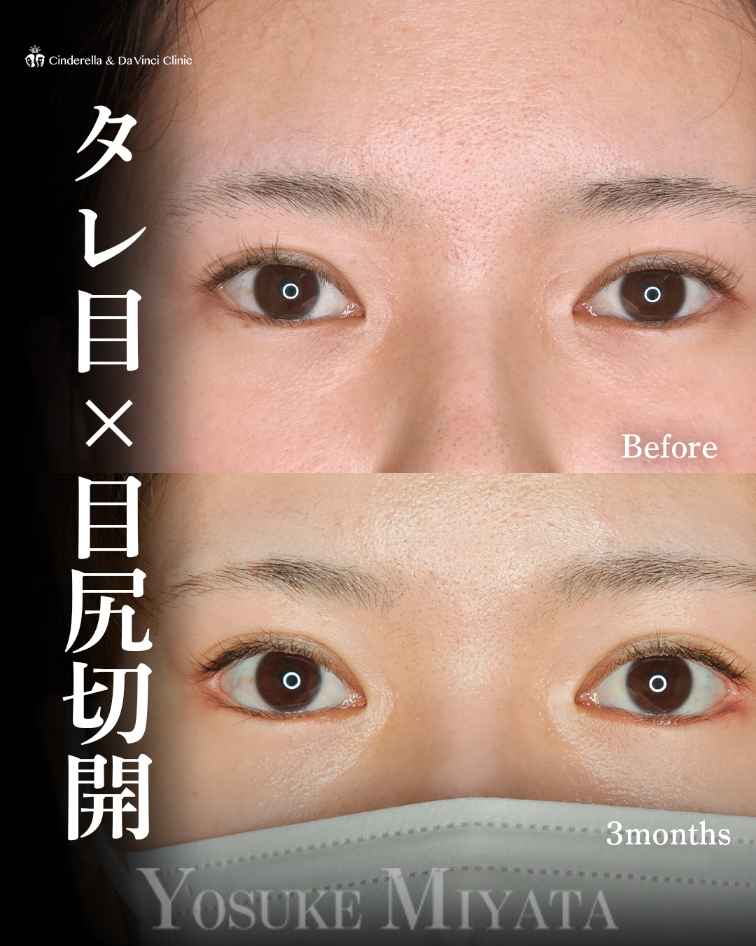 目を大きく見せるの画像