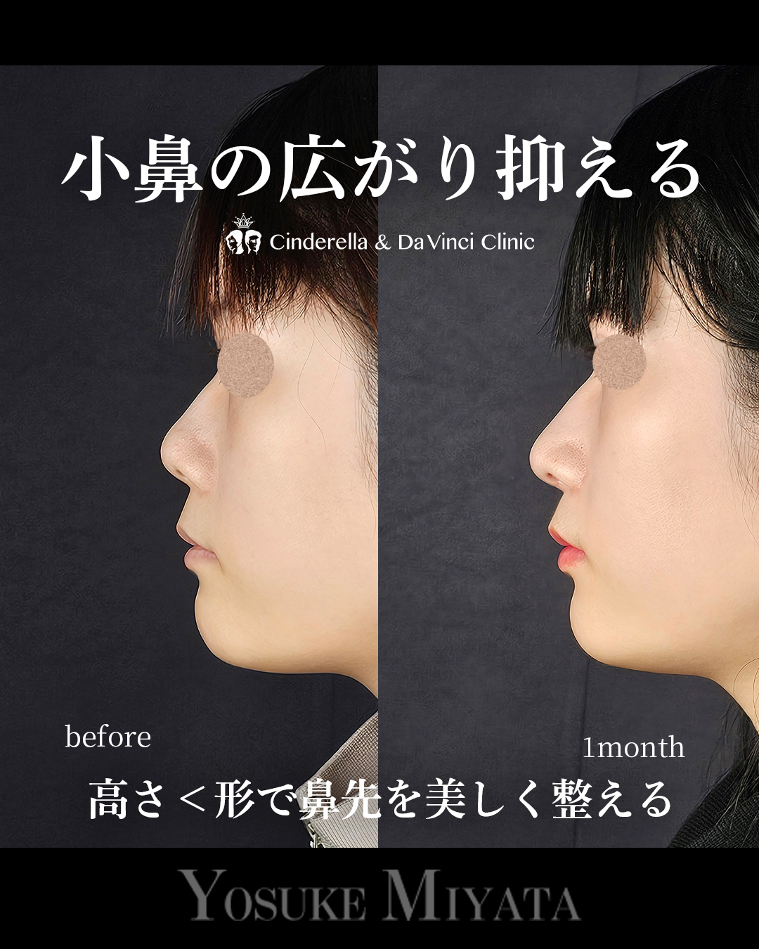小鼻の広がり抑えるの画像