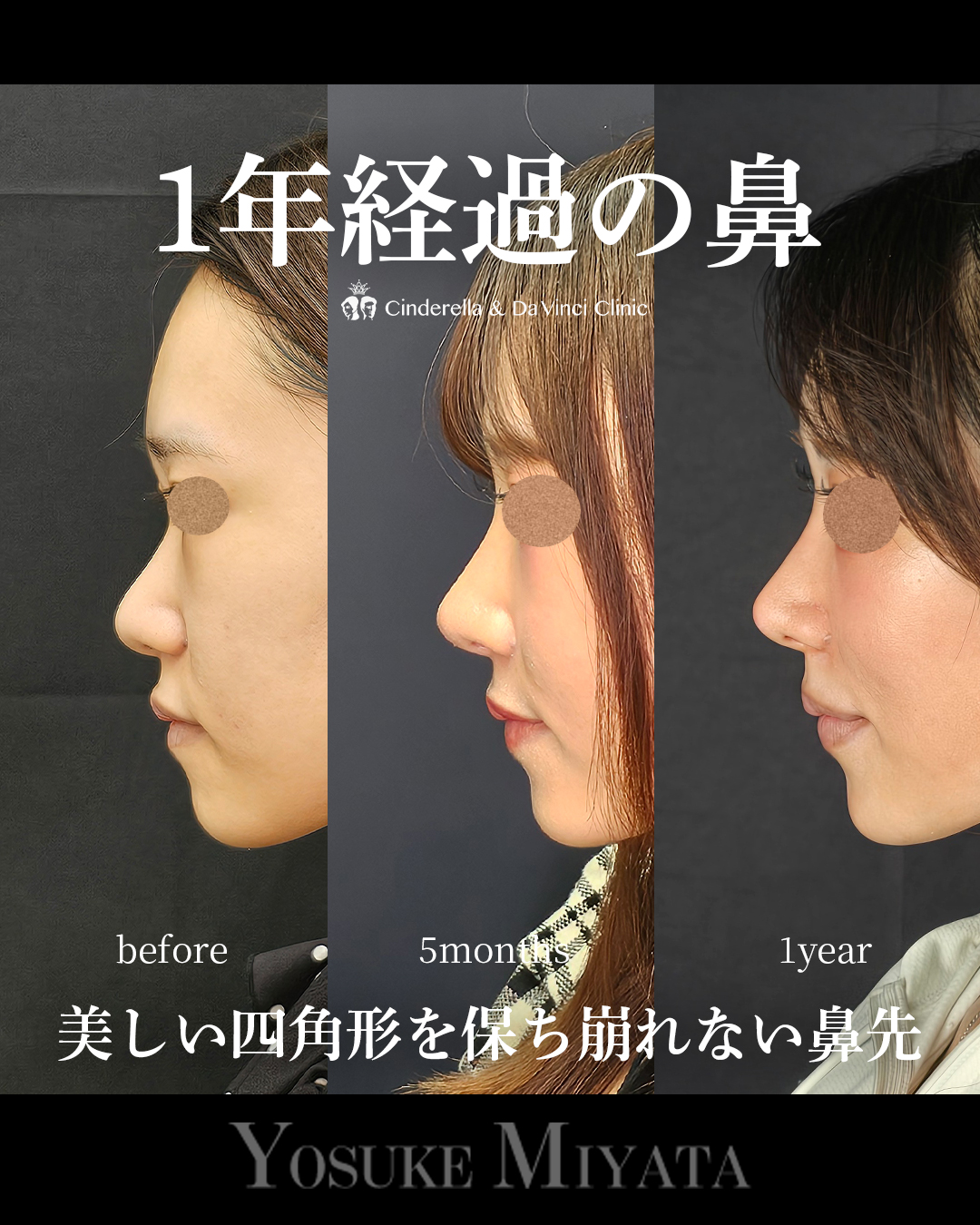 1年経過の鼻の画像