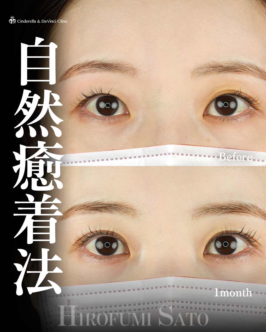 埋没で左右差改善の画像