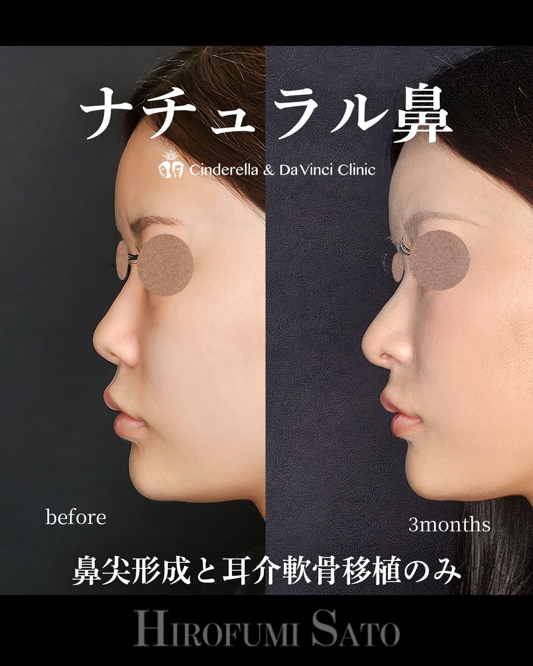 ナチュラル鼻の画像