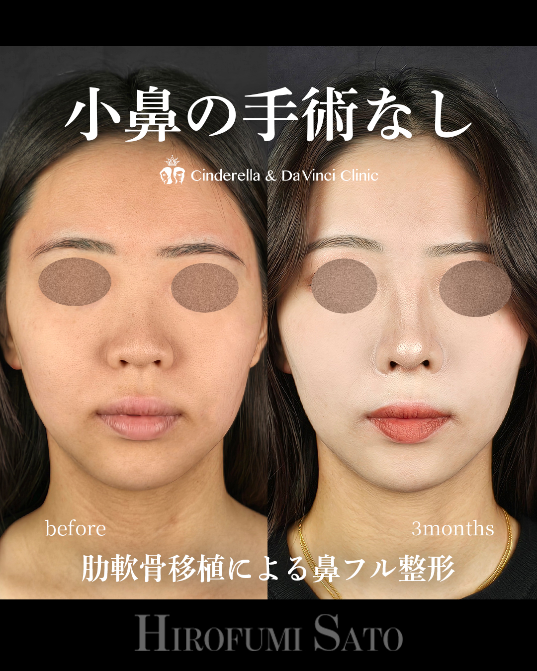 小鼻の手術なしの画像