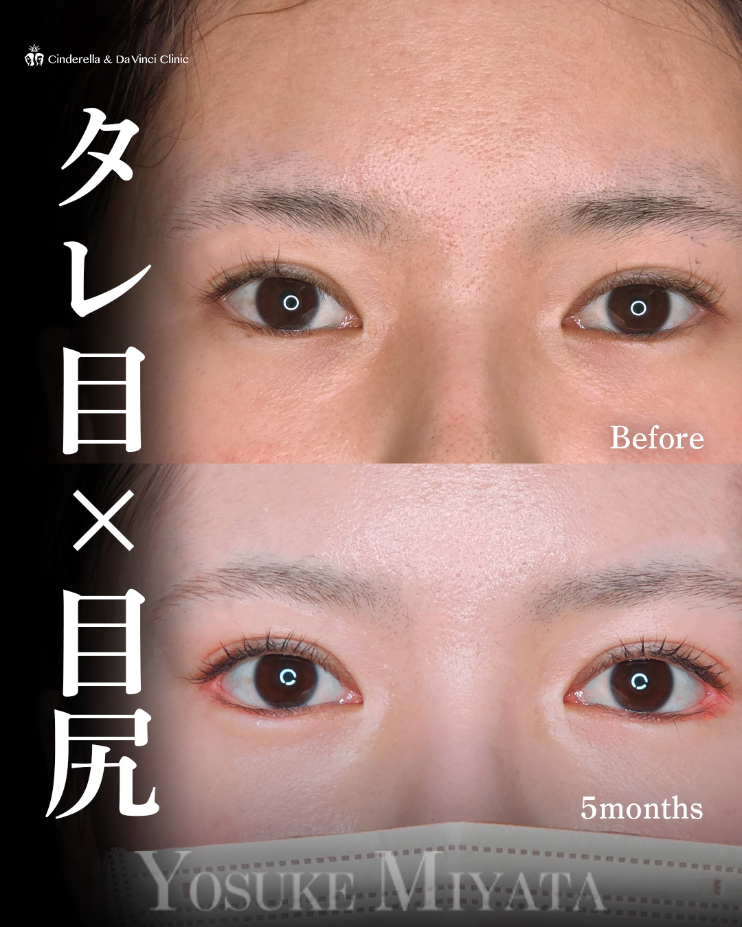 目を大きく見せるの画像