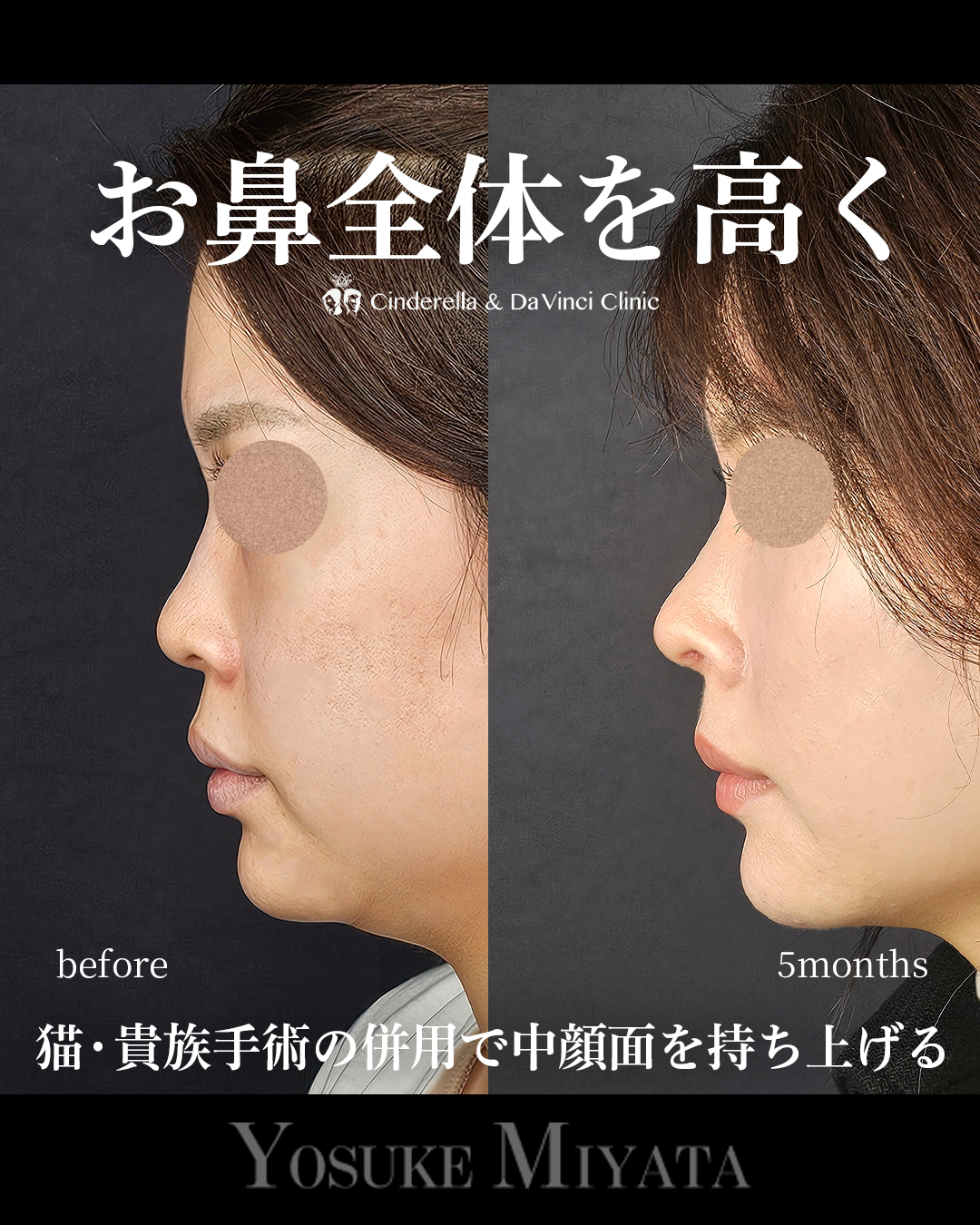 鼻全体を高くの画像