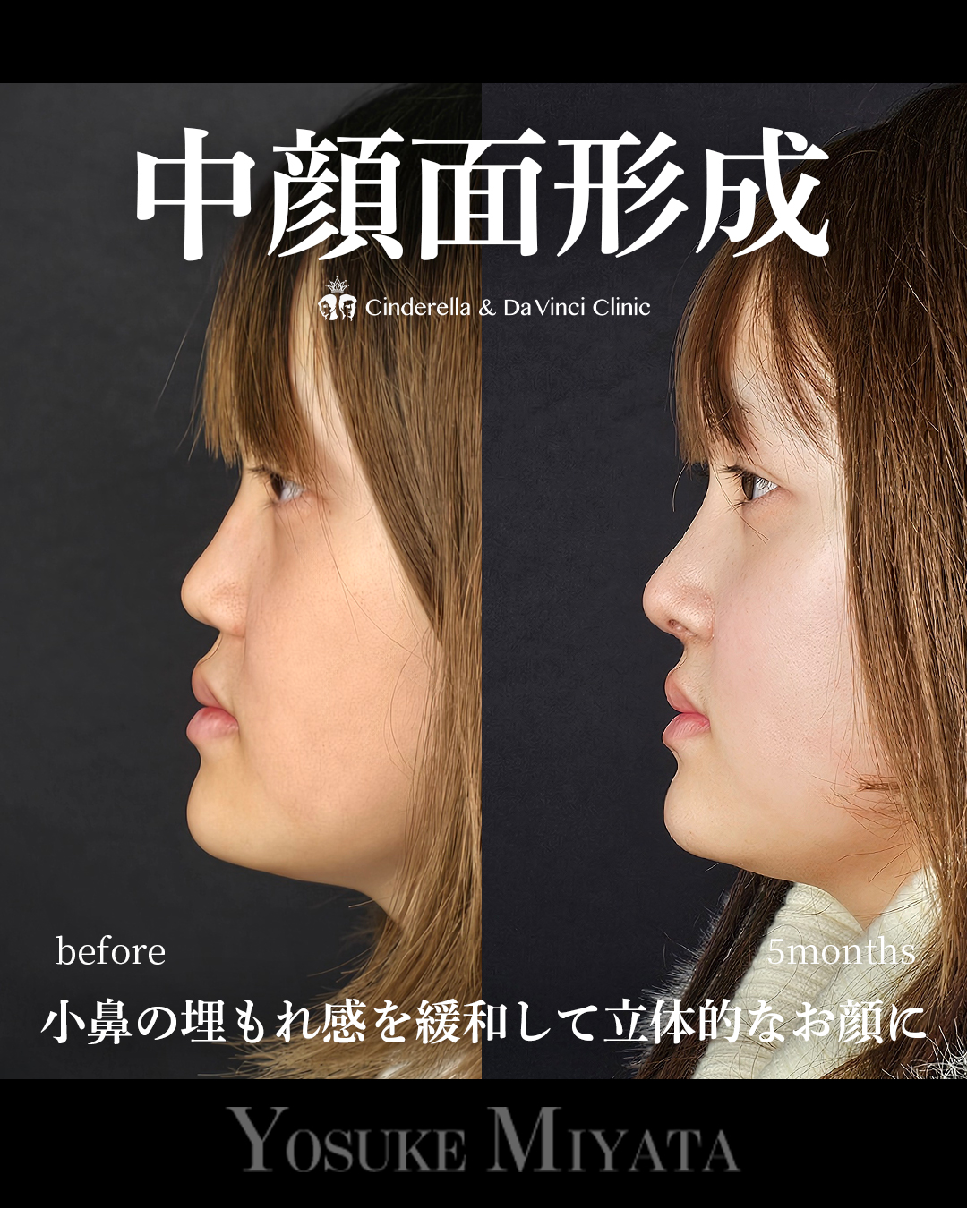 鼻整形で中顔面形成の画像