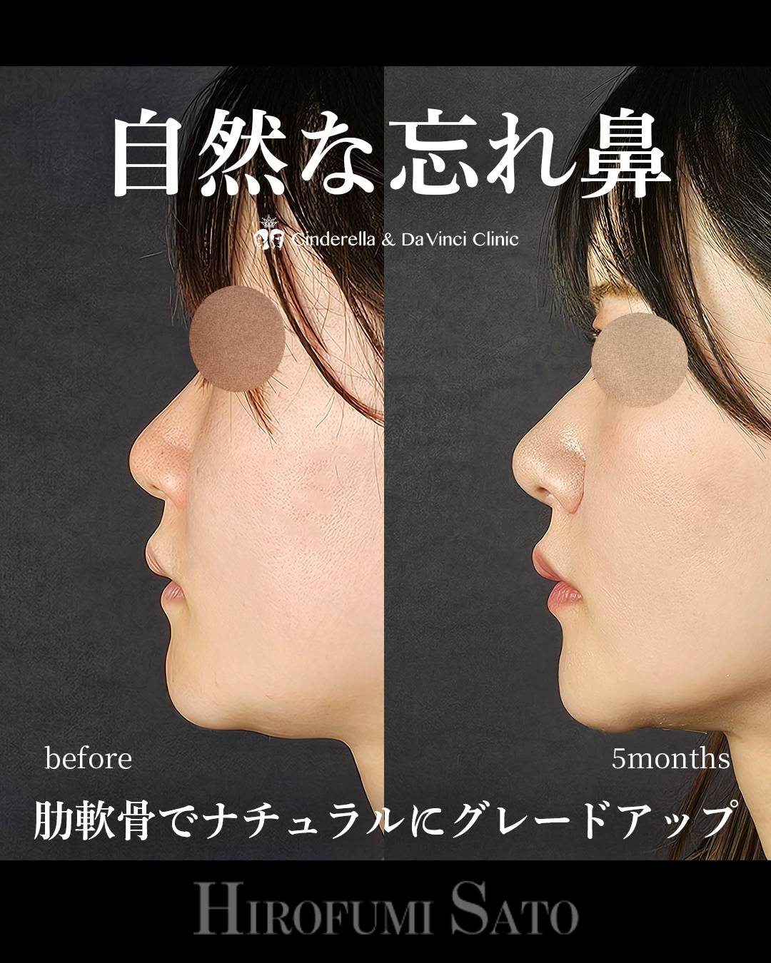 肋軟骨で自然な忘れ鼻の画像