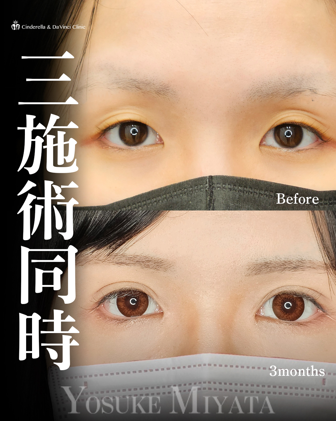 目を大きくするの画像