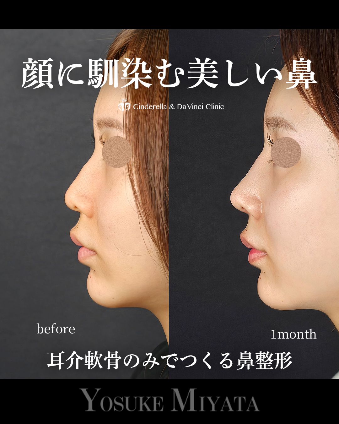 顔に馴染む鼻の画像