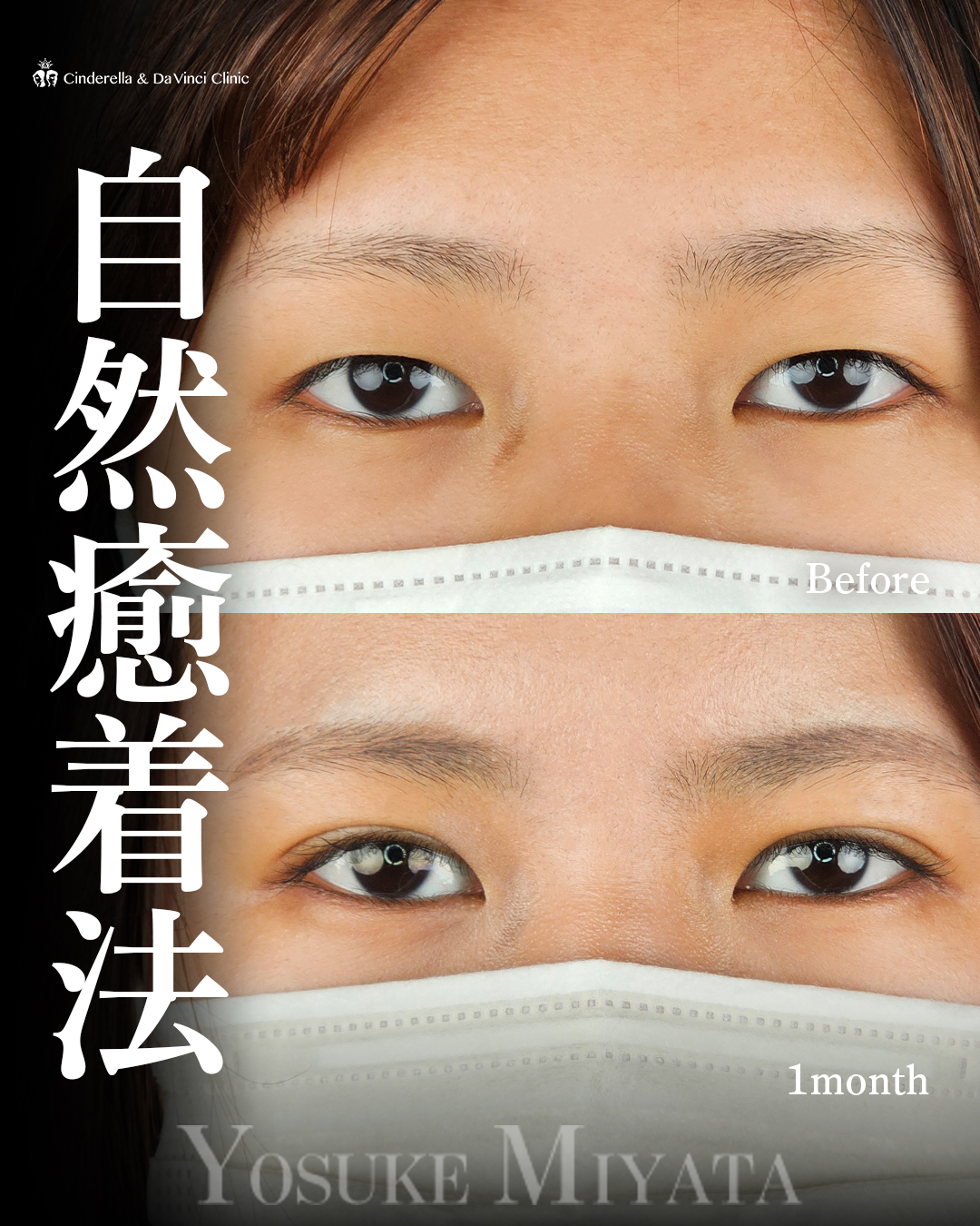 自然で可愛い二重の画像