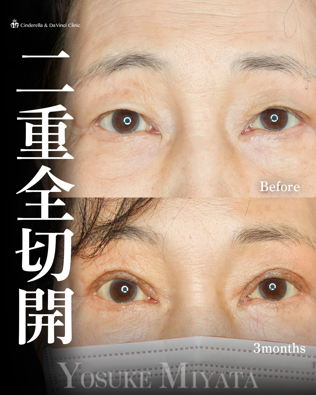 60代の全切開の画像