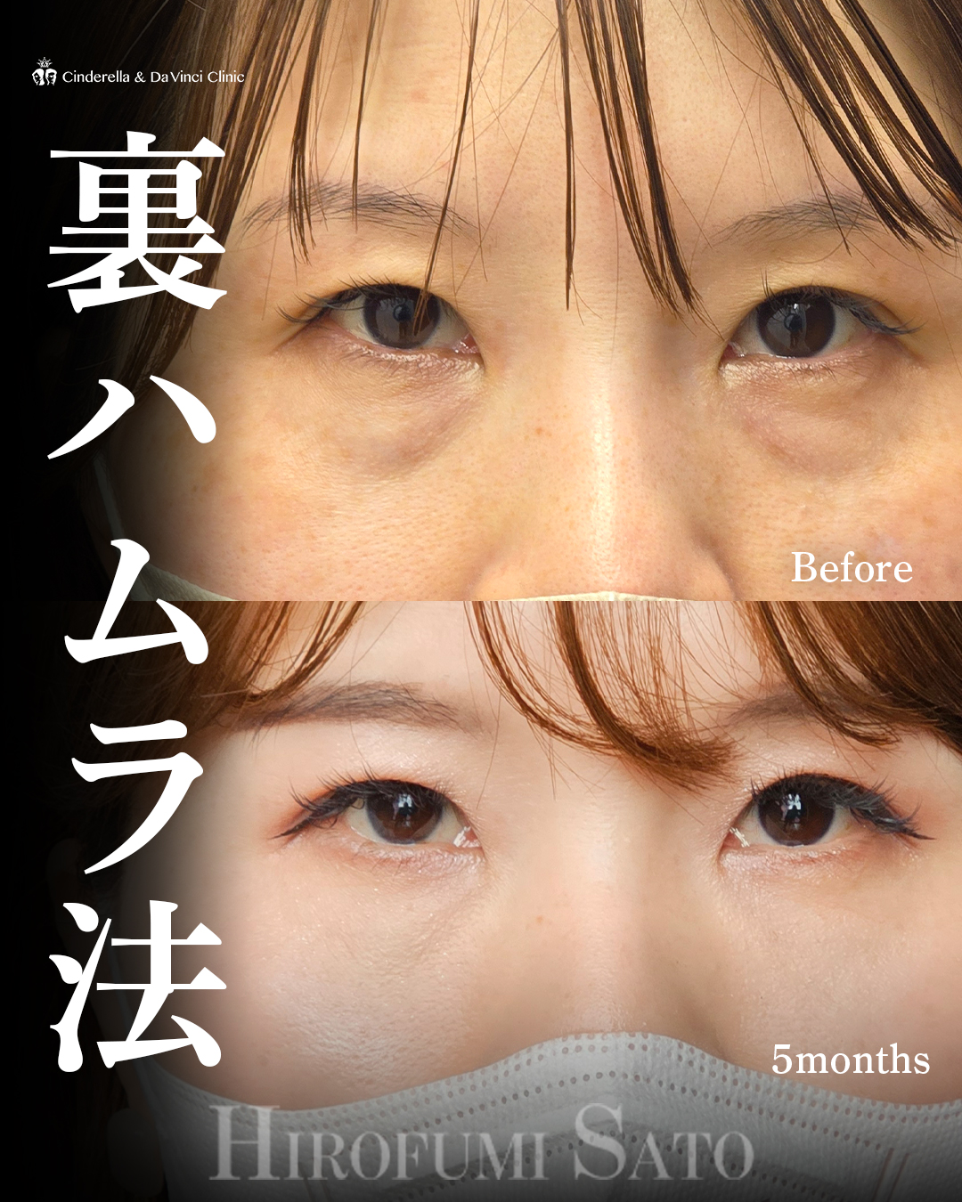 クマ取りで-10歳の画像