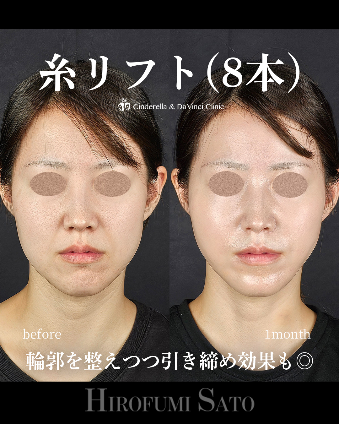 糸リフトで整えるの画像