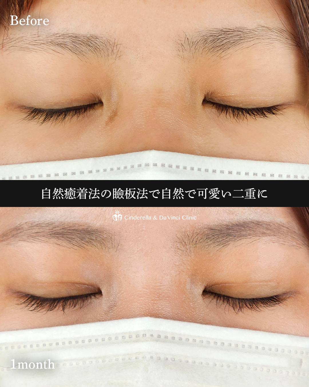自然で可愛い二重の画像