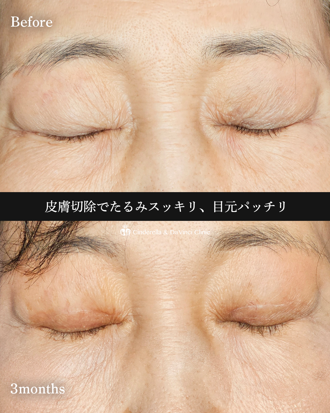 60代の全切開の画像