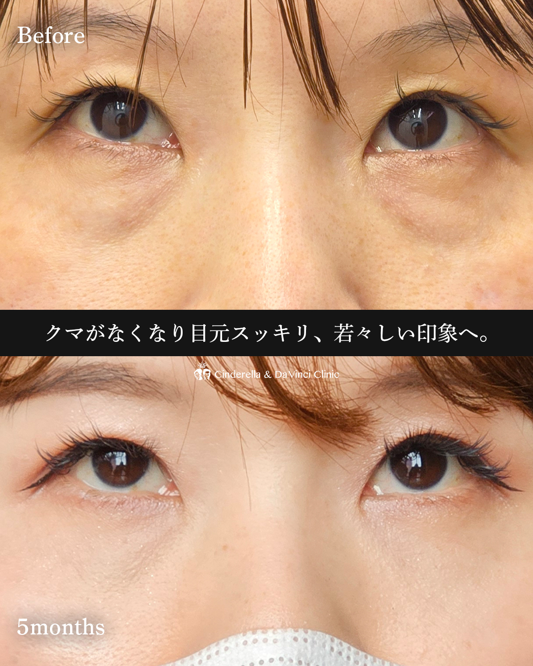 クマ取りで-10歳の画像