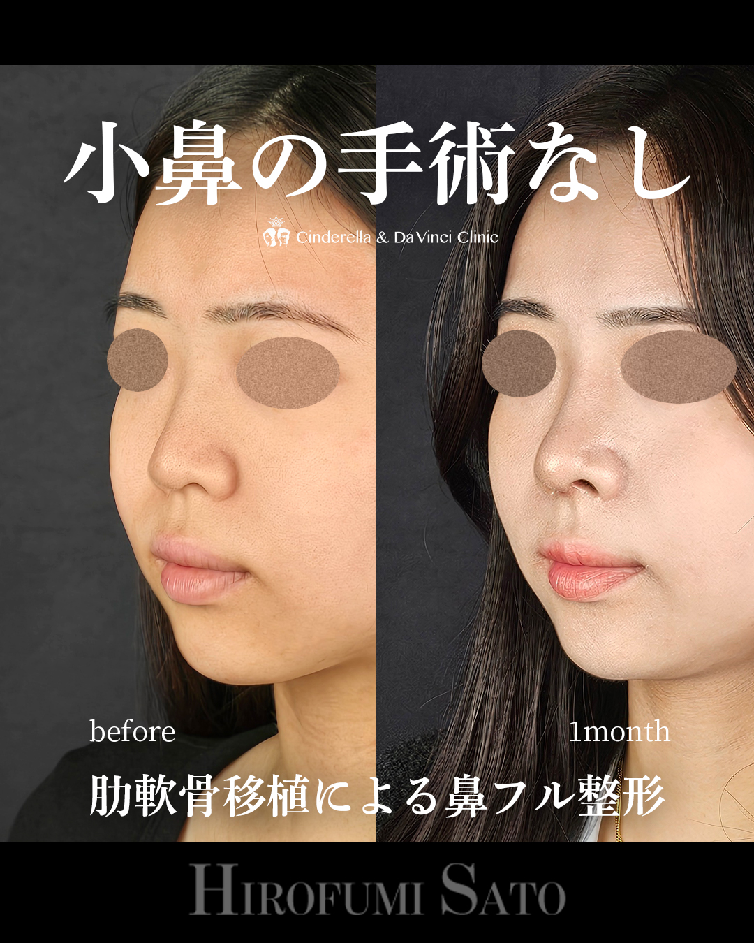 小鼻の手術なしの画像