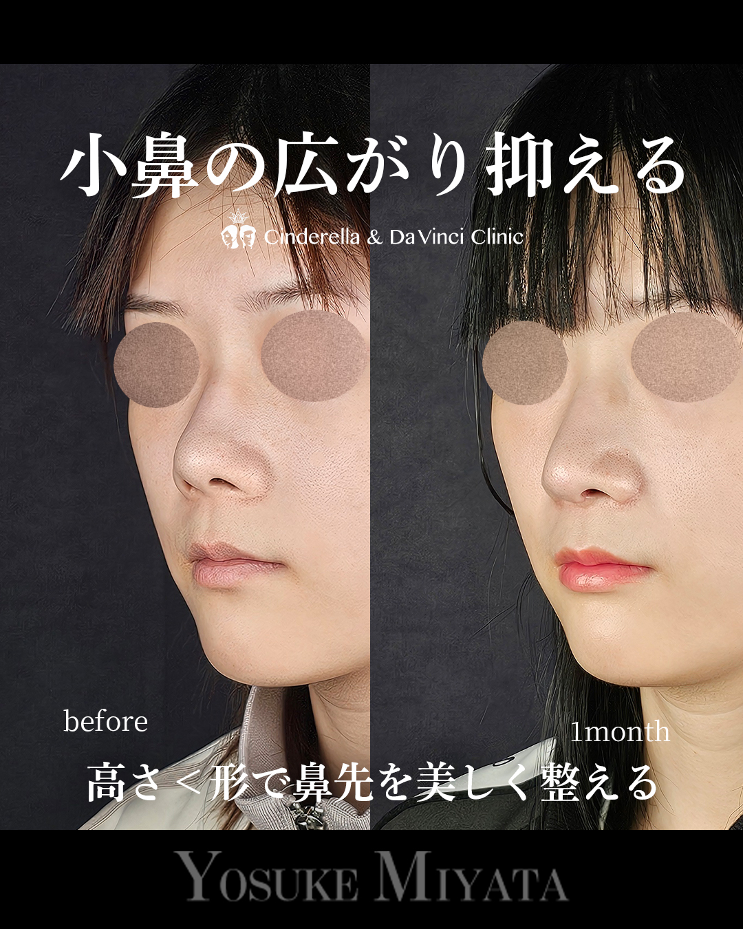 小鼻の広がり抑えるの画像