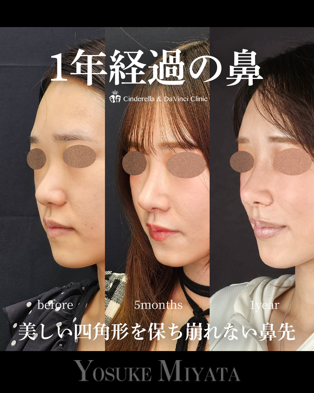 1年経過の鼻の画像