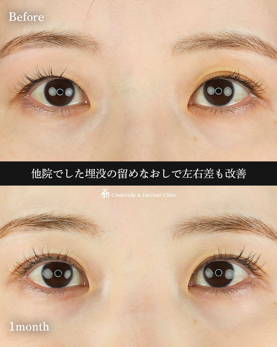 埋没で左右差改善の画像