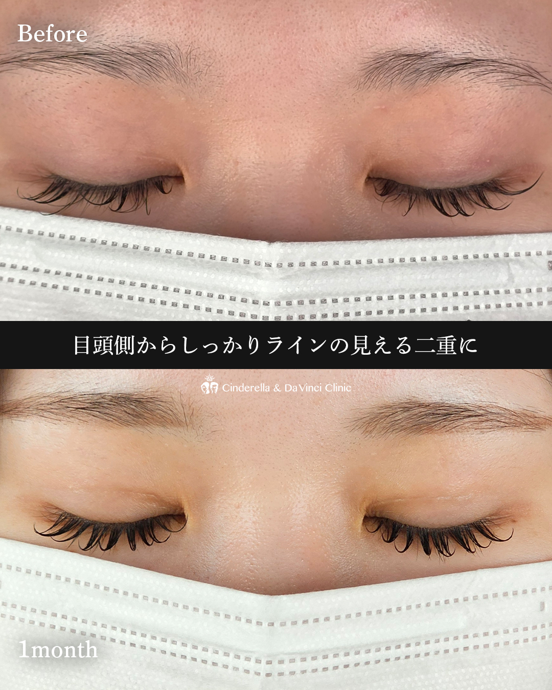 まつ毛が映える二重の画像