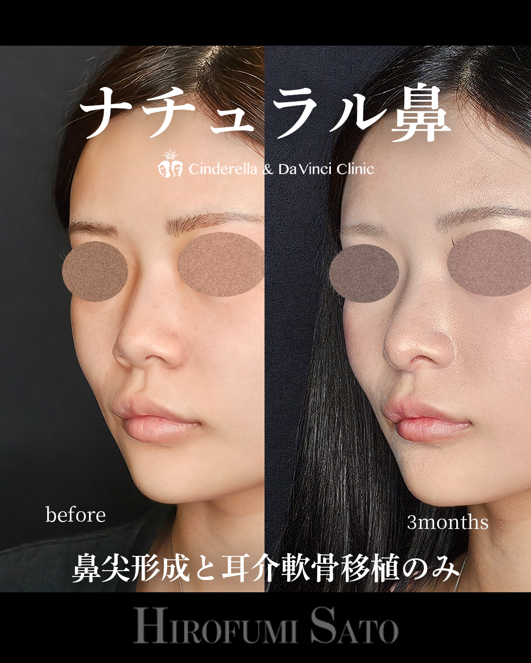 ナチュラル鼻の画像