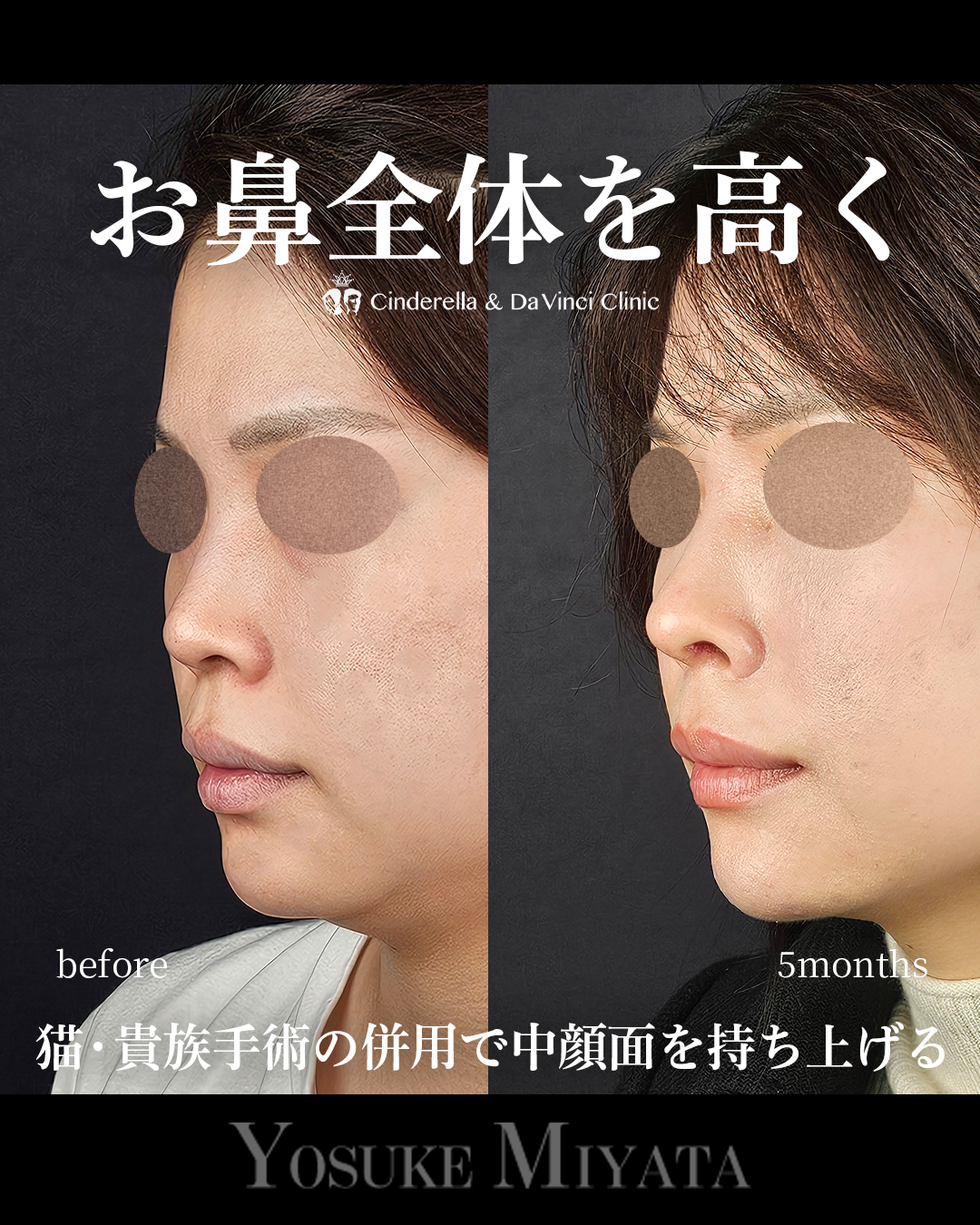 鼻全体を高くの画像