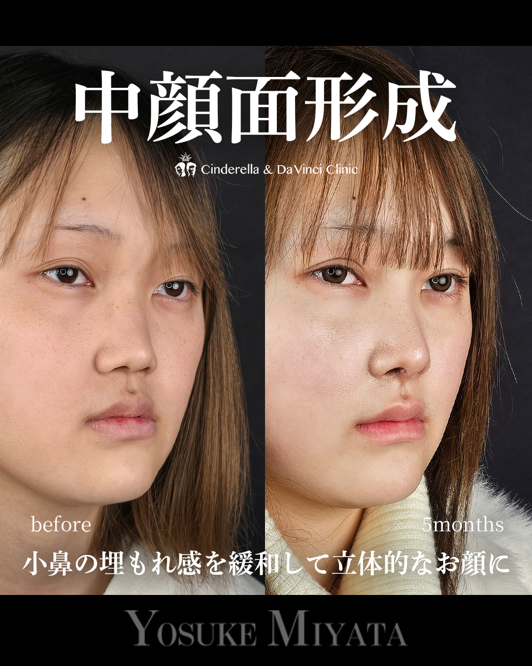 鼻整形で中顔面形成の画像