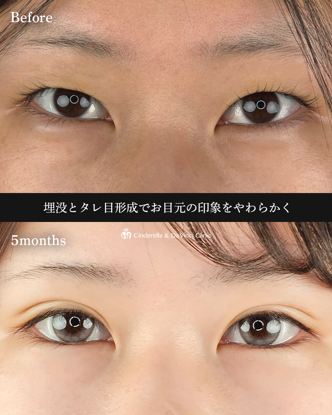 ツリ目をタレ目にの画像
