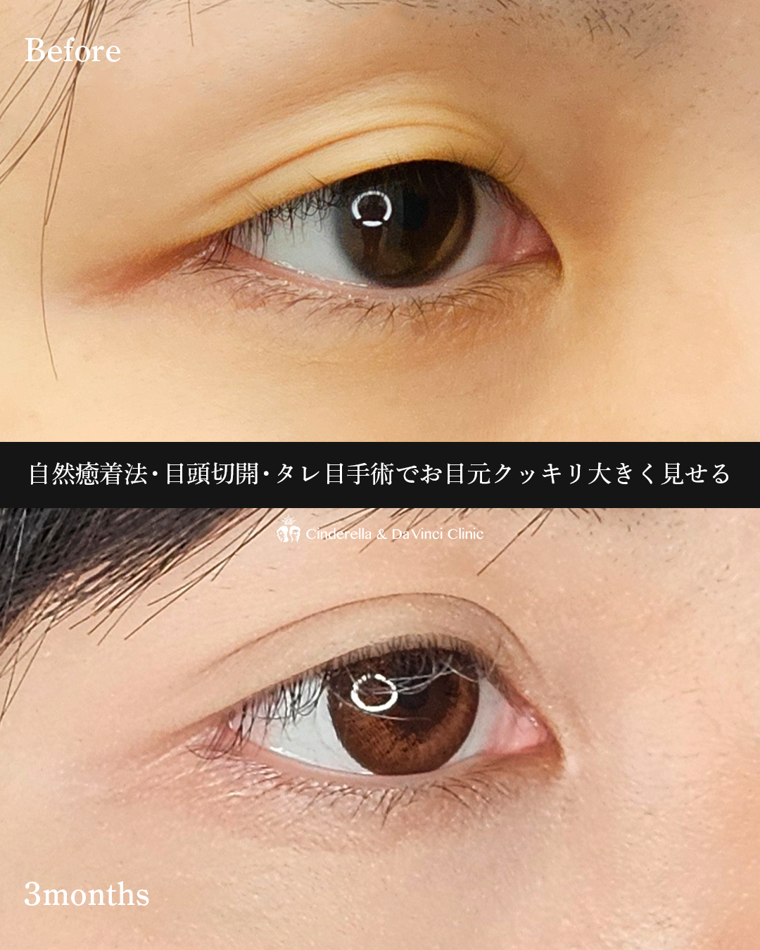 目を大きくするの画像