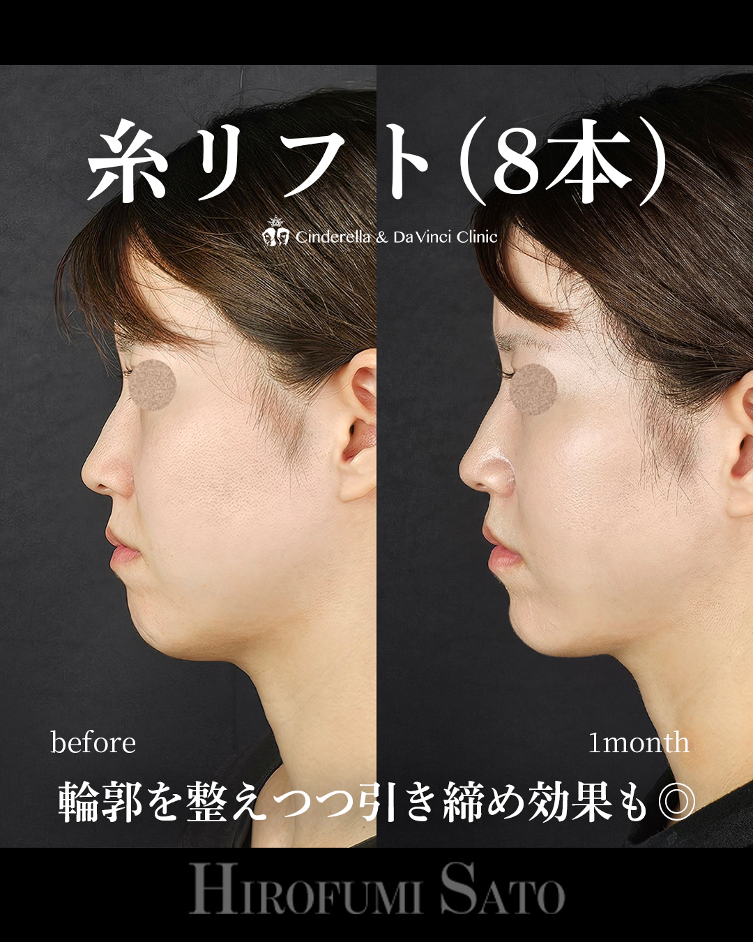 糸リフトで整えるの画像