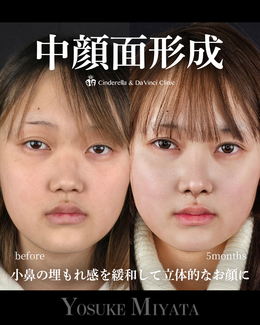 鼻整形で中顔面形成の画像