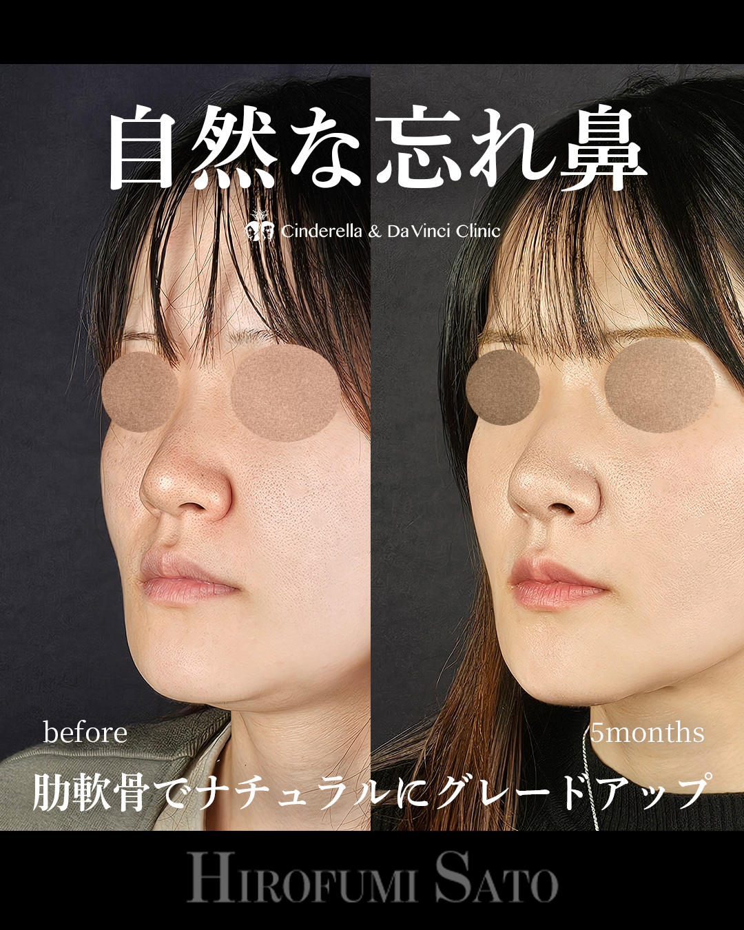 肋軟骨で自然な忘れ鼻の画像