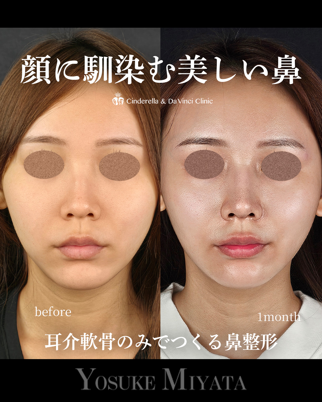 顔に馴染む鼻の画像