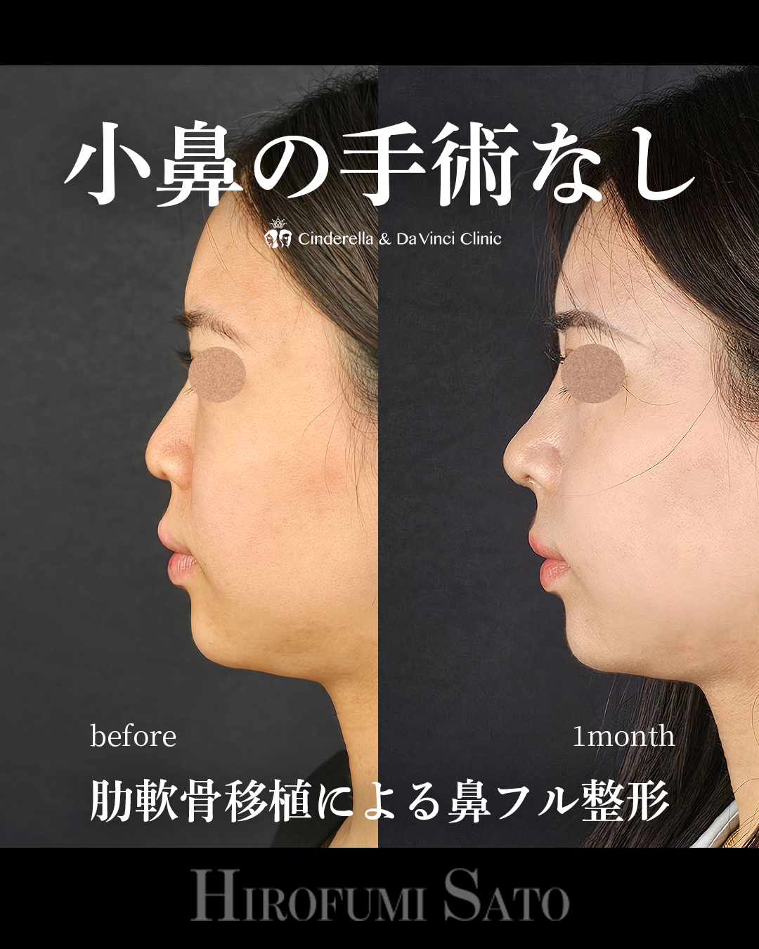 小鼻の手術なしの画像