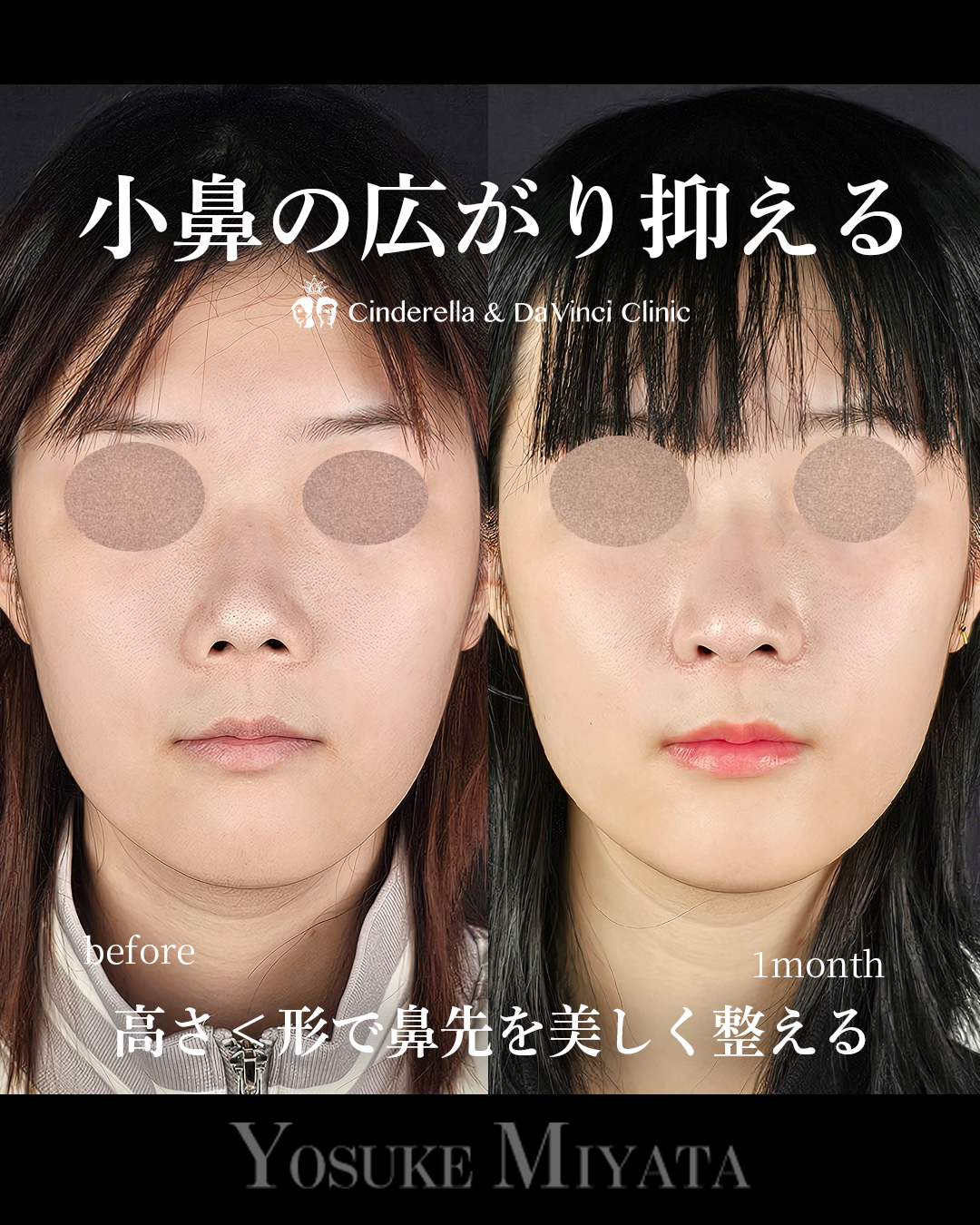小鼻の広がり抑えるの画像