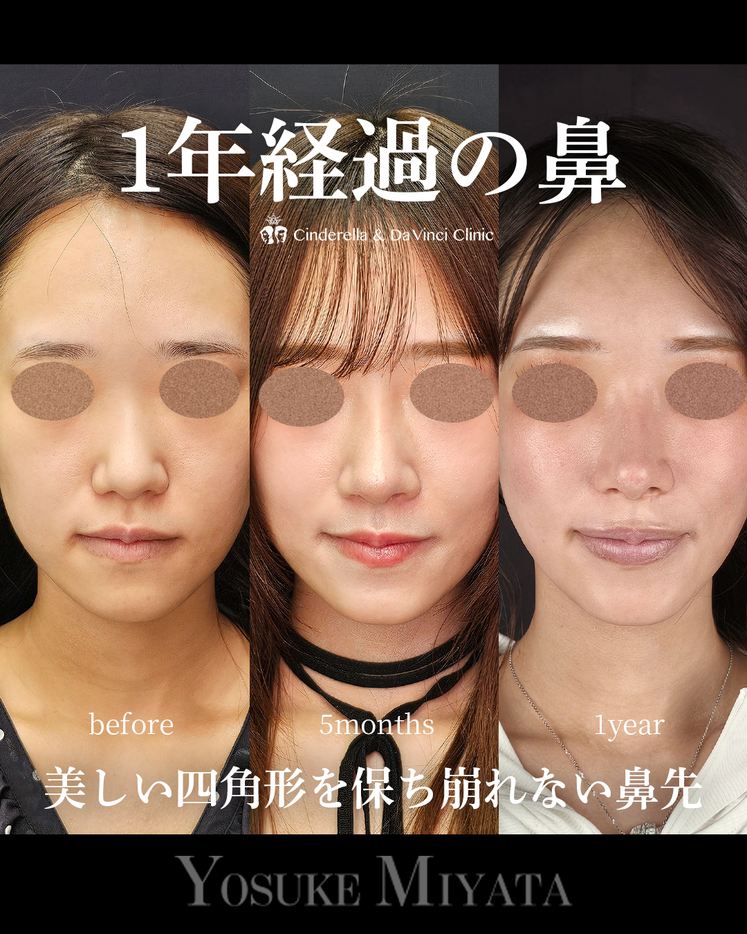 1年経過の鼻の画像