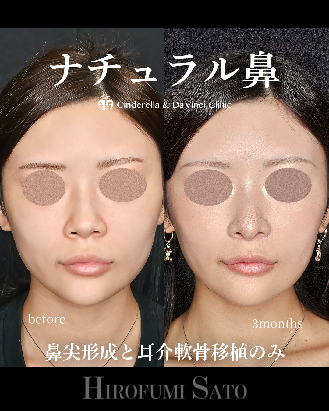 ナチュラル鼻の画像