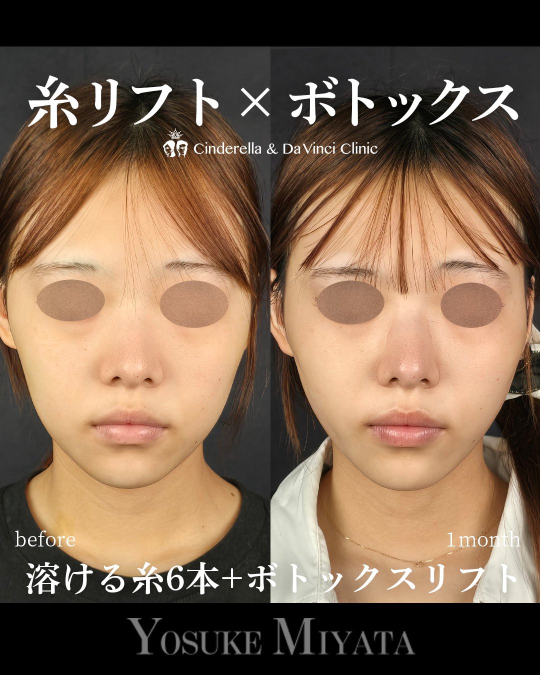 糸リフトとボトックスリフトの画像