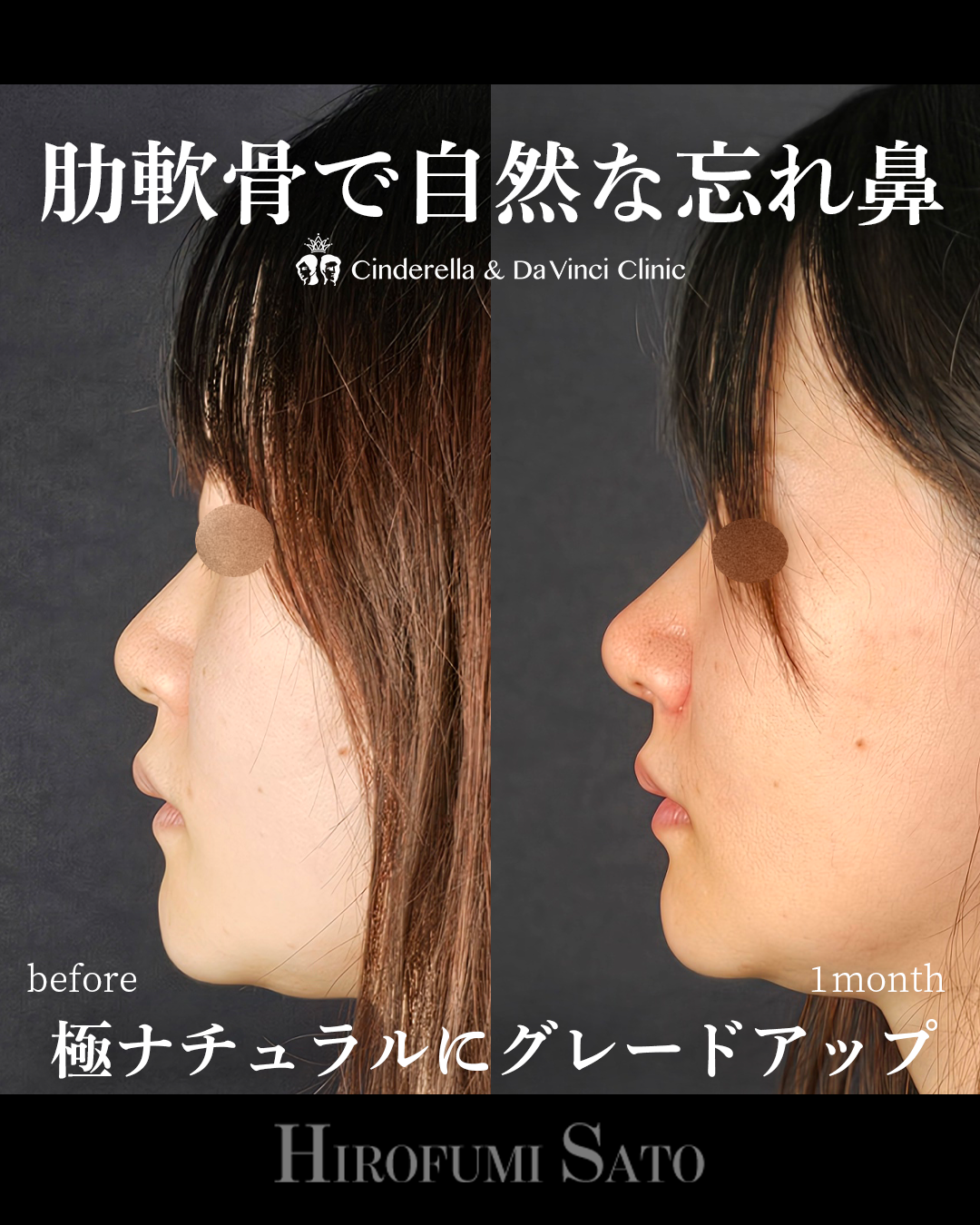 肋軟骨で自然な忘れ鼻の画像