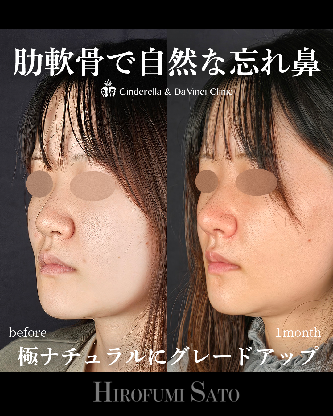 肋軟骨で自然な忘れ鼻の画像