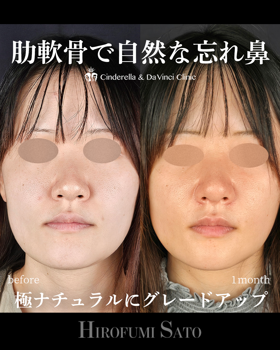 肋軟骨で自然な忘れ鼻の画像