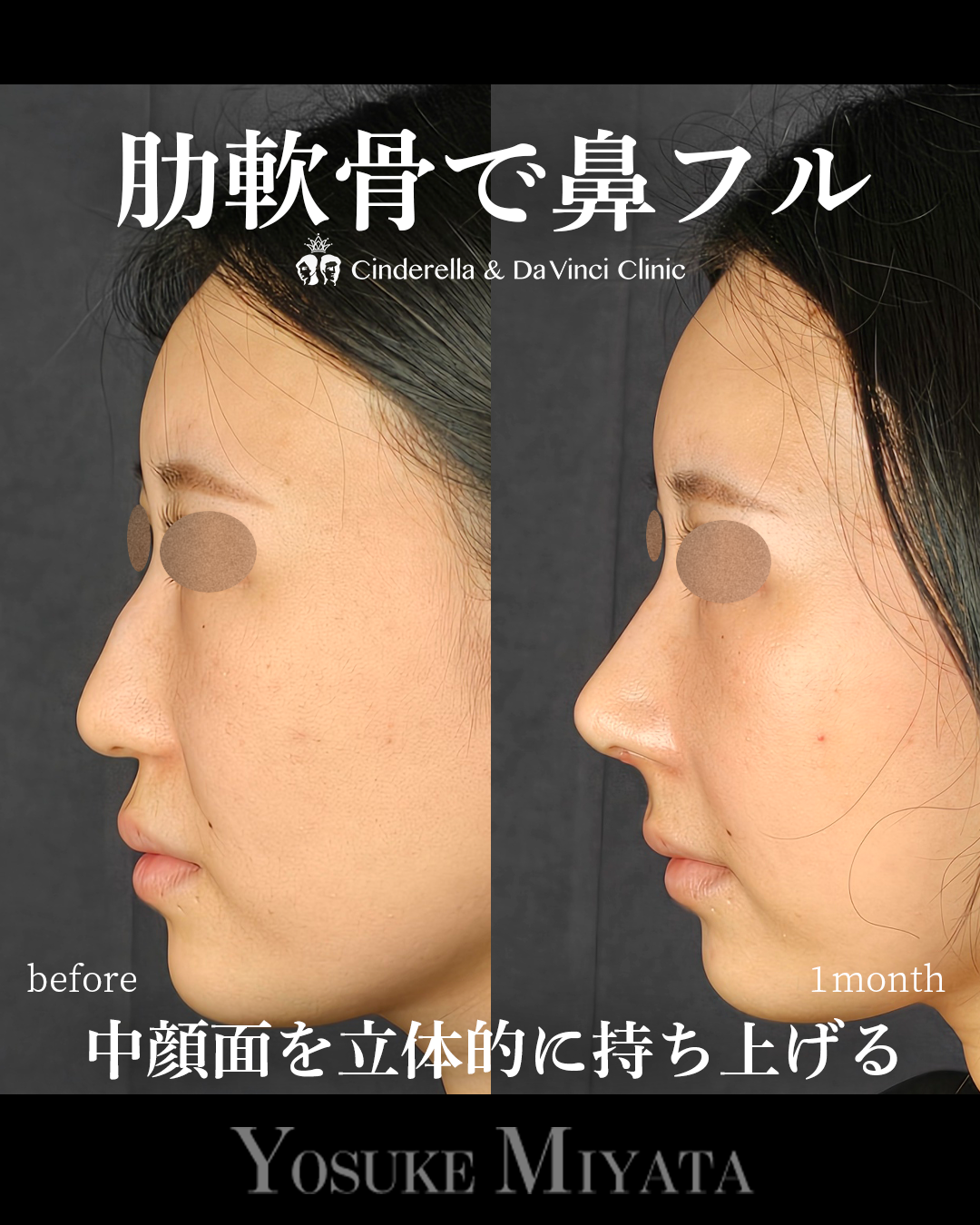 肋軟骨の鼻フルの画像