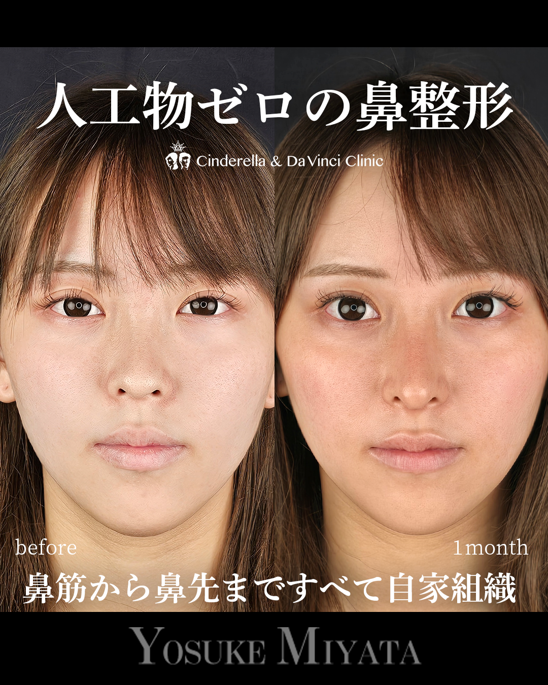 人工物なしの鼻整形の画像