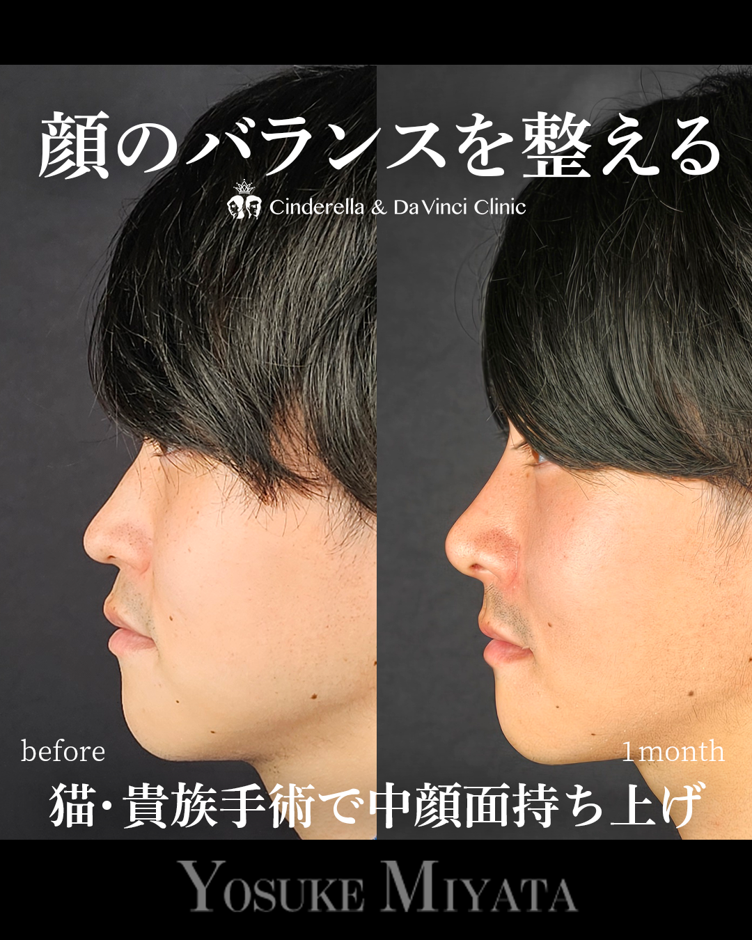 鼻整形で顔のバランスを整えるの画像