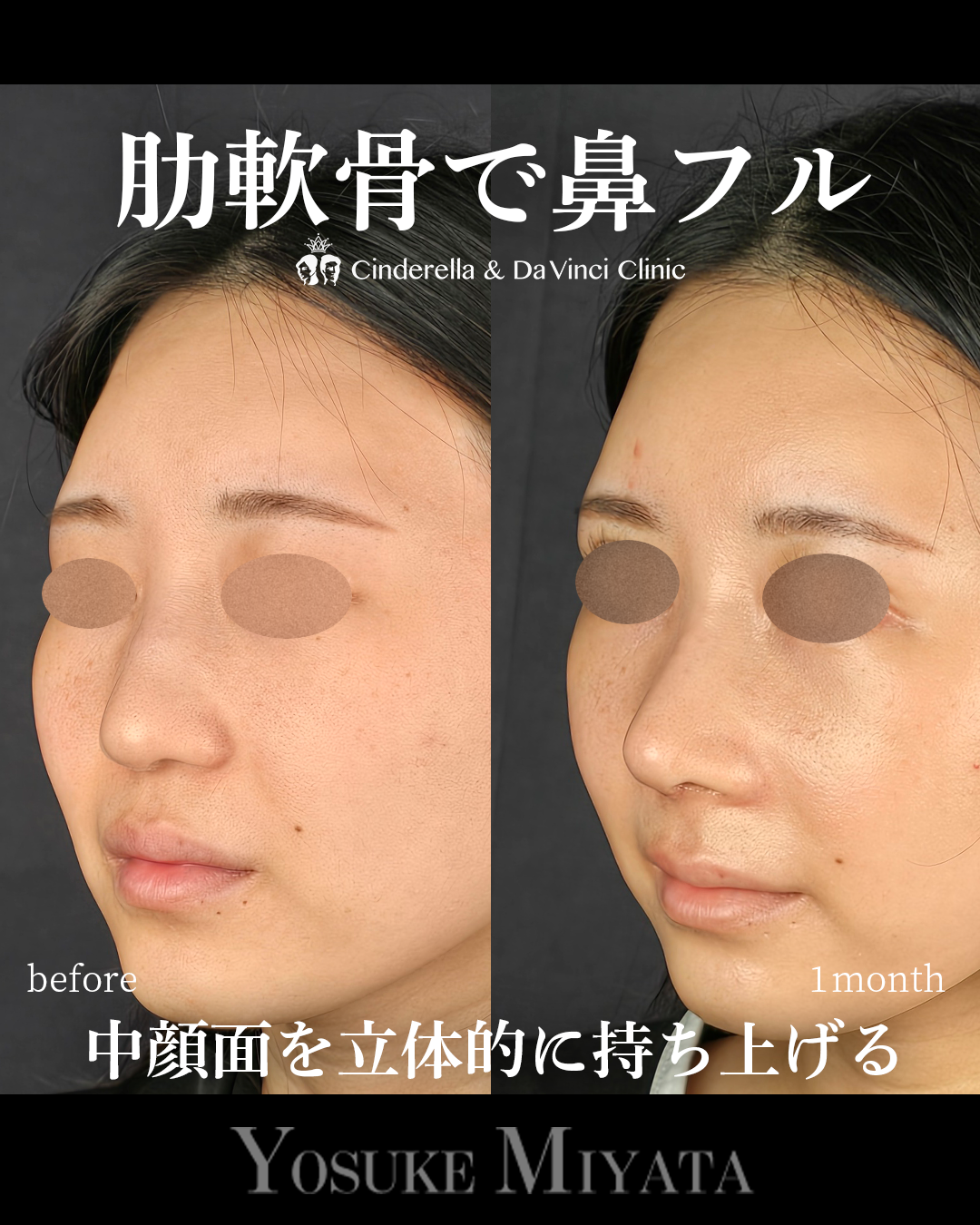 肋軟骨の鼻フルの画像