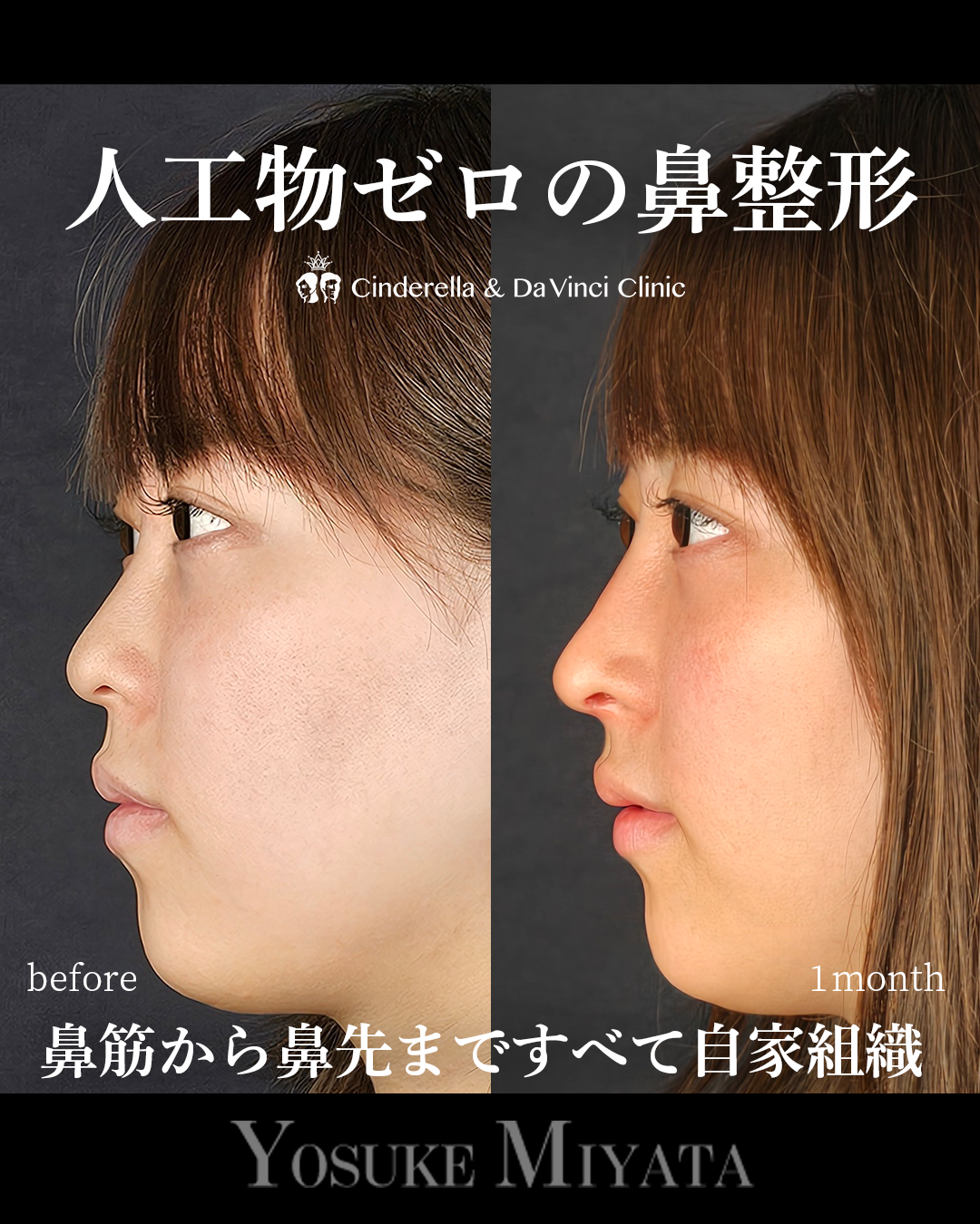人工物なしの鼻整形の画像