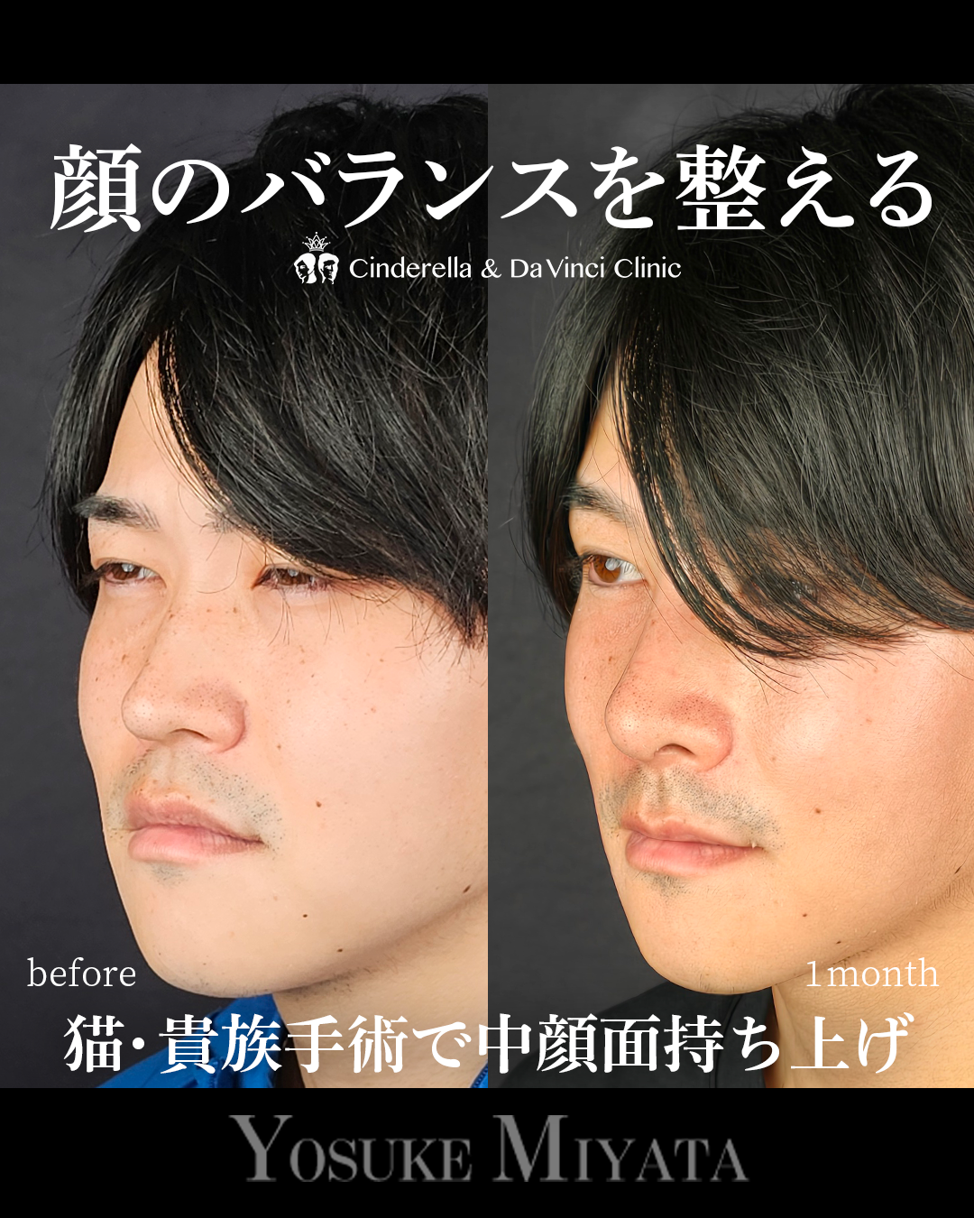 鼻整形で顔のバランスを整えるの画像