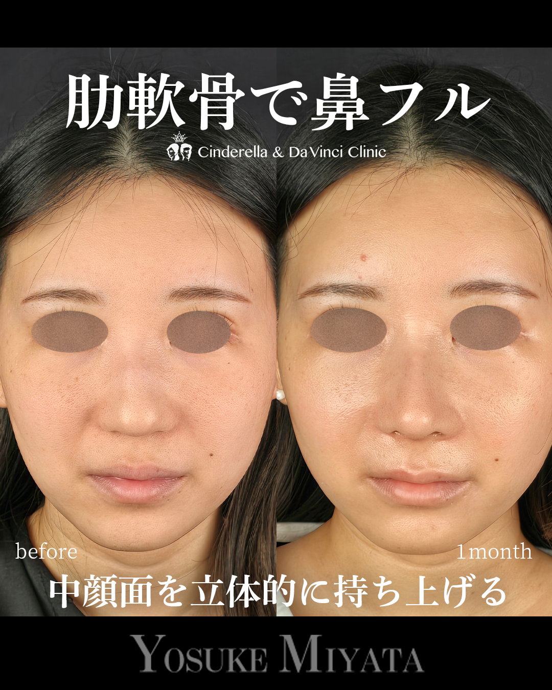 肋軟骨の鼻フルの画像