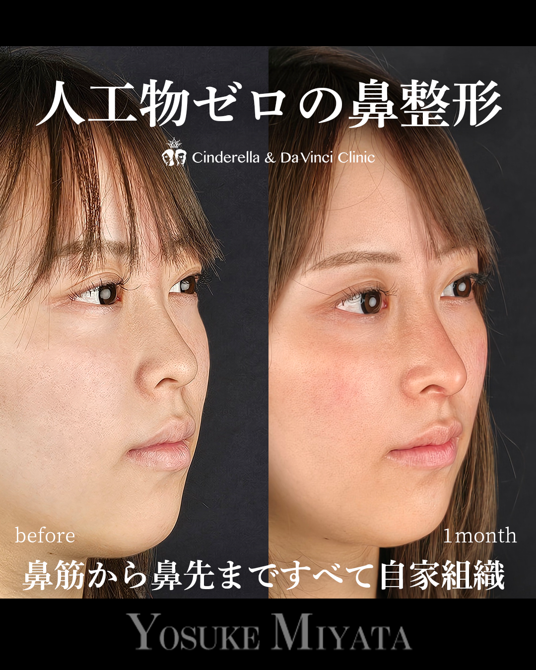 人工物なしの鼻整形の画像